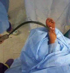 مستشفى إدكو المركزى بالبحيرة تنجح في انقاذ ذراع طفل من البتر