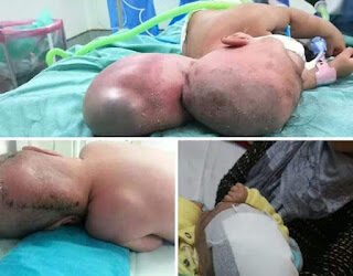 إستئصال كيس مائي ضخم وتقويم عظام الجمجمة لطفل في الشهر الثاني من العمر بمستشفى المنصورة...
