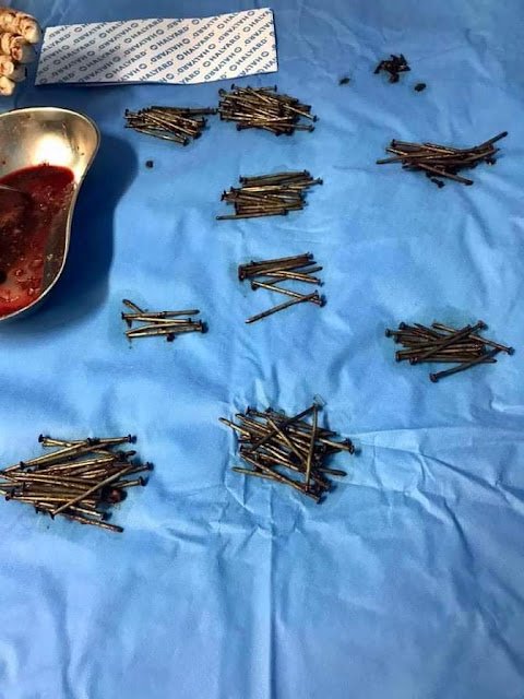 فريق طبي ينجح باستخراج 230 مسمارا من بطن مريض في جدة بالسعودية فريق طبي ينجح باستخراج 230 مسمارا من بطن مريض في جدة بالسعودية